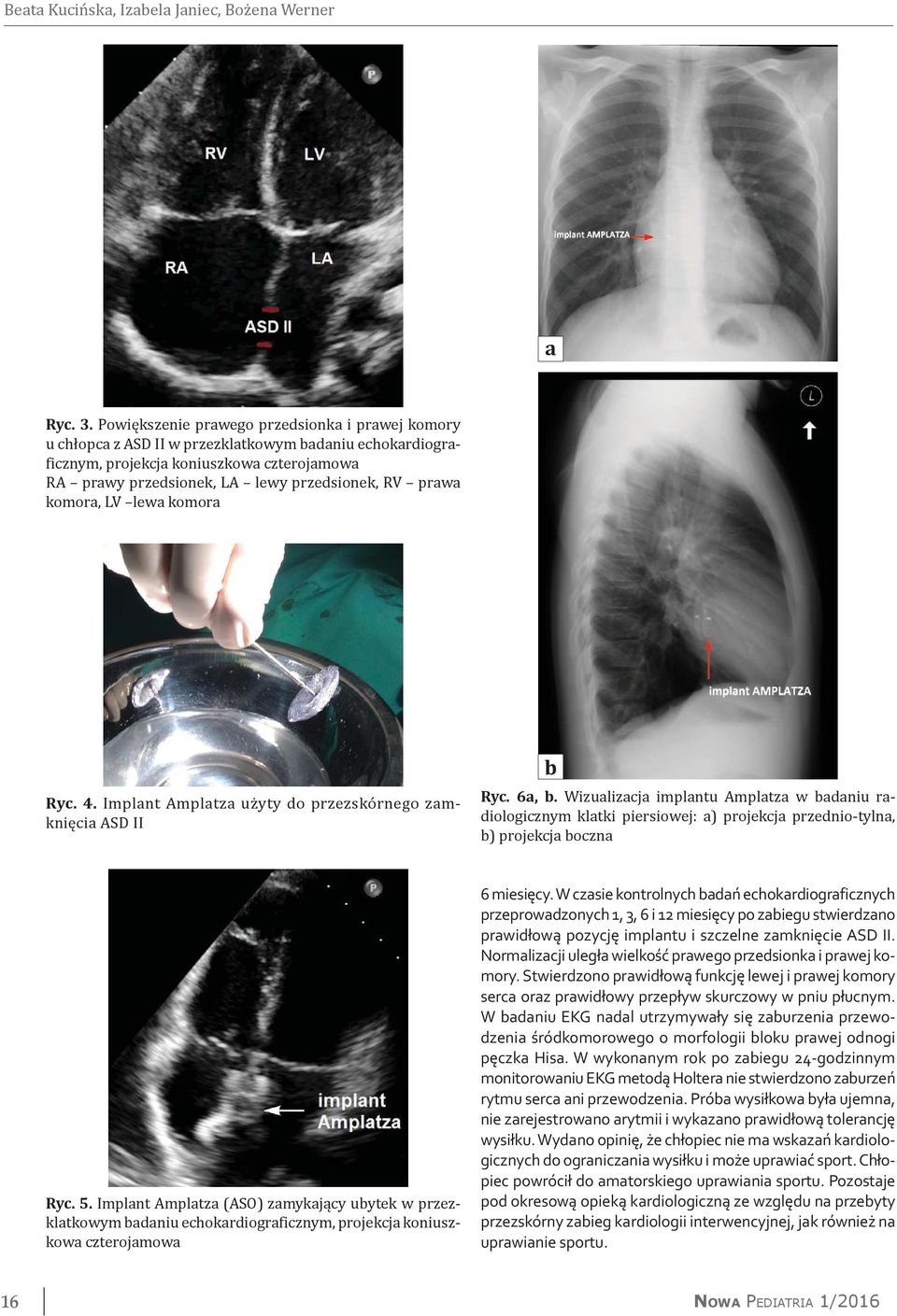 prawa komora, LV lewa komora Ryc. 4. Implant Amplatza użyty do przezskórnego zamknięcia ASD II b Ryc. 6a, b.