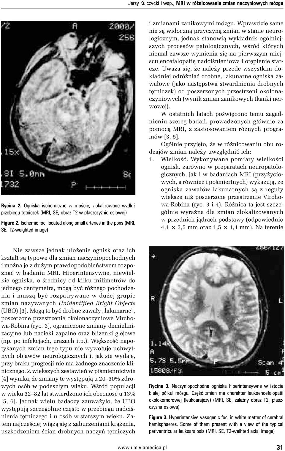 Ischemic foci located along small arteries in the pons (MRI, SE, T2-weighted image) i zmianami zanikowymi mózgu.