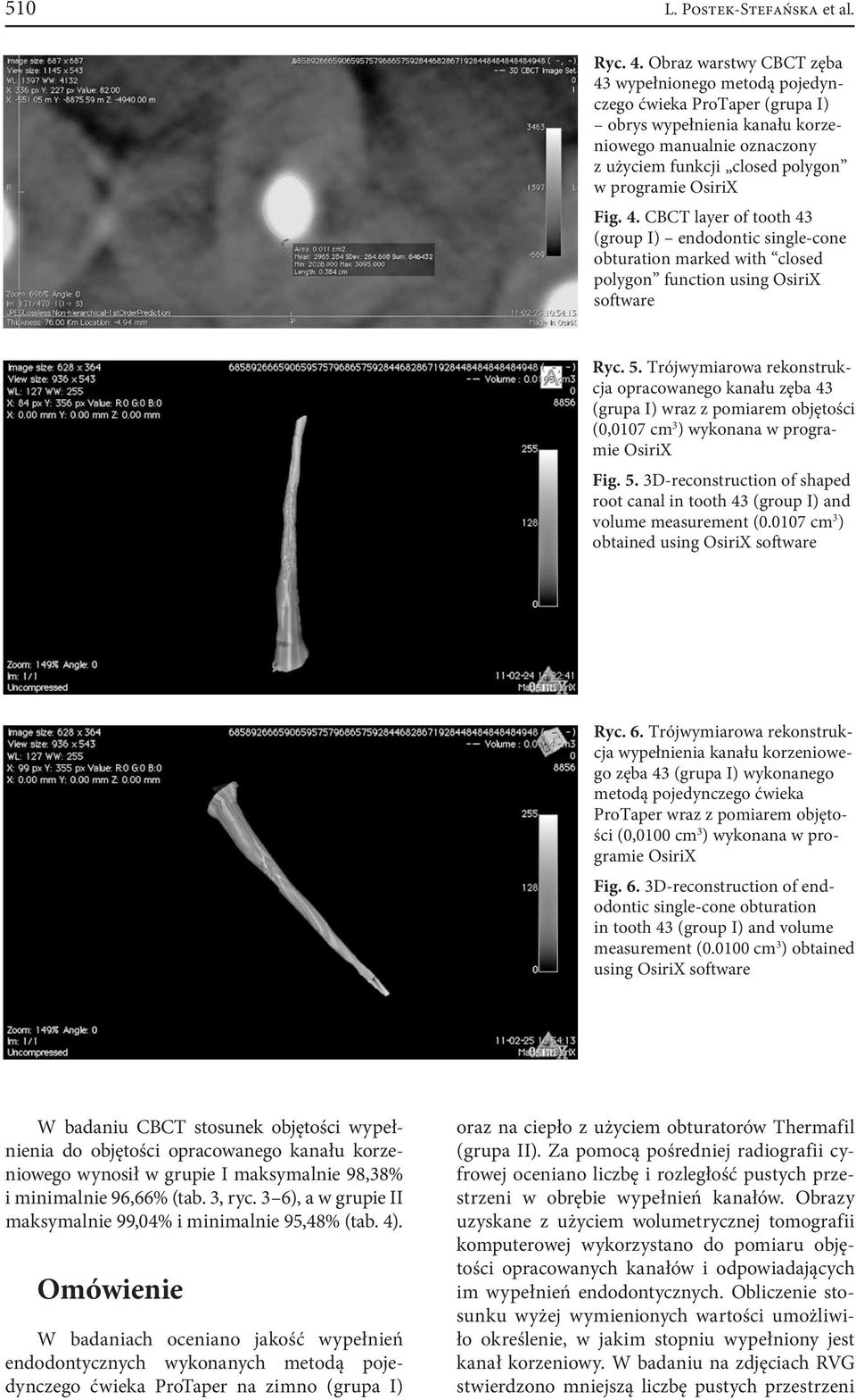 4. CBCT layer of tooth 43 (group I) endodontic single-cone obturation marked with closed polygon function using OsiriX software Ryc. 5.