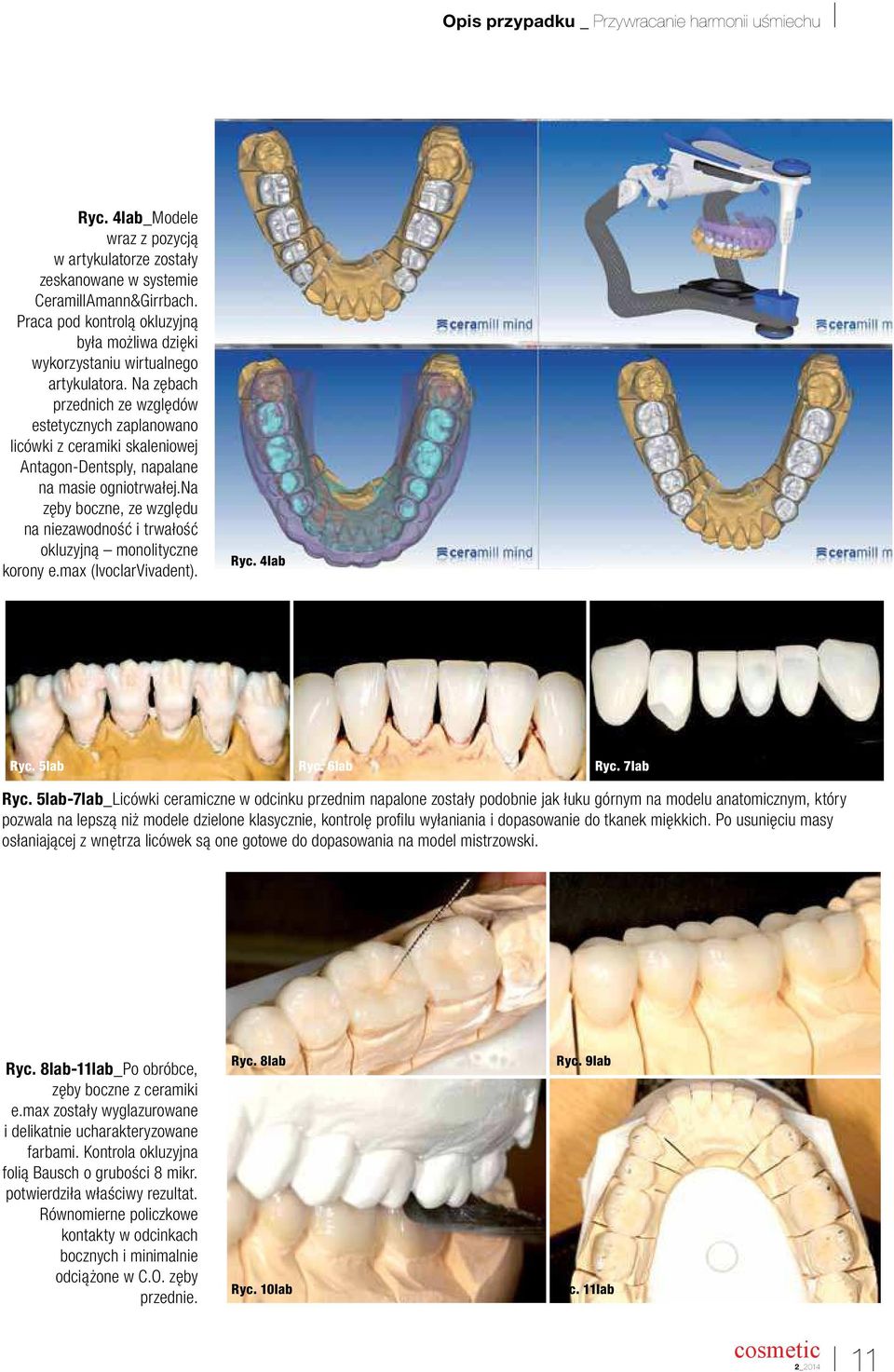na zęby boczne, ze względu na niezawodność i trwałość okluzyjną monolityczne korony e.max (IvoclarVivadent). Ryc. 4lab Ryc. 5lab Ryc. 6lab Ryc. 7lab Ryc.