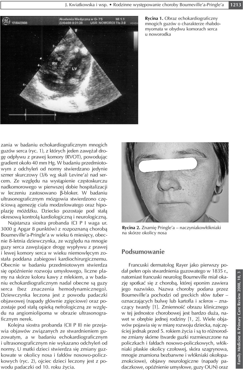 1), z których jeden zawężał dro gę odpływu z prawej komory (RVOT), powodując gradient około 40 mm Hg.