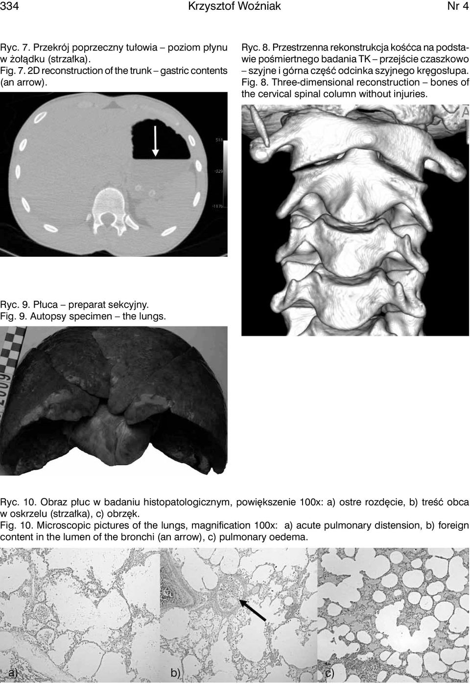 Three-dimensional reconstruction bones of the cervical spinal column without injuries. Ryc. 9. Płuca preparat sekcyjny. Fig. 9. Autopsy specimen the lungs. Ryc. 10.