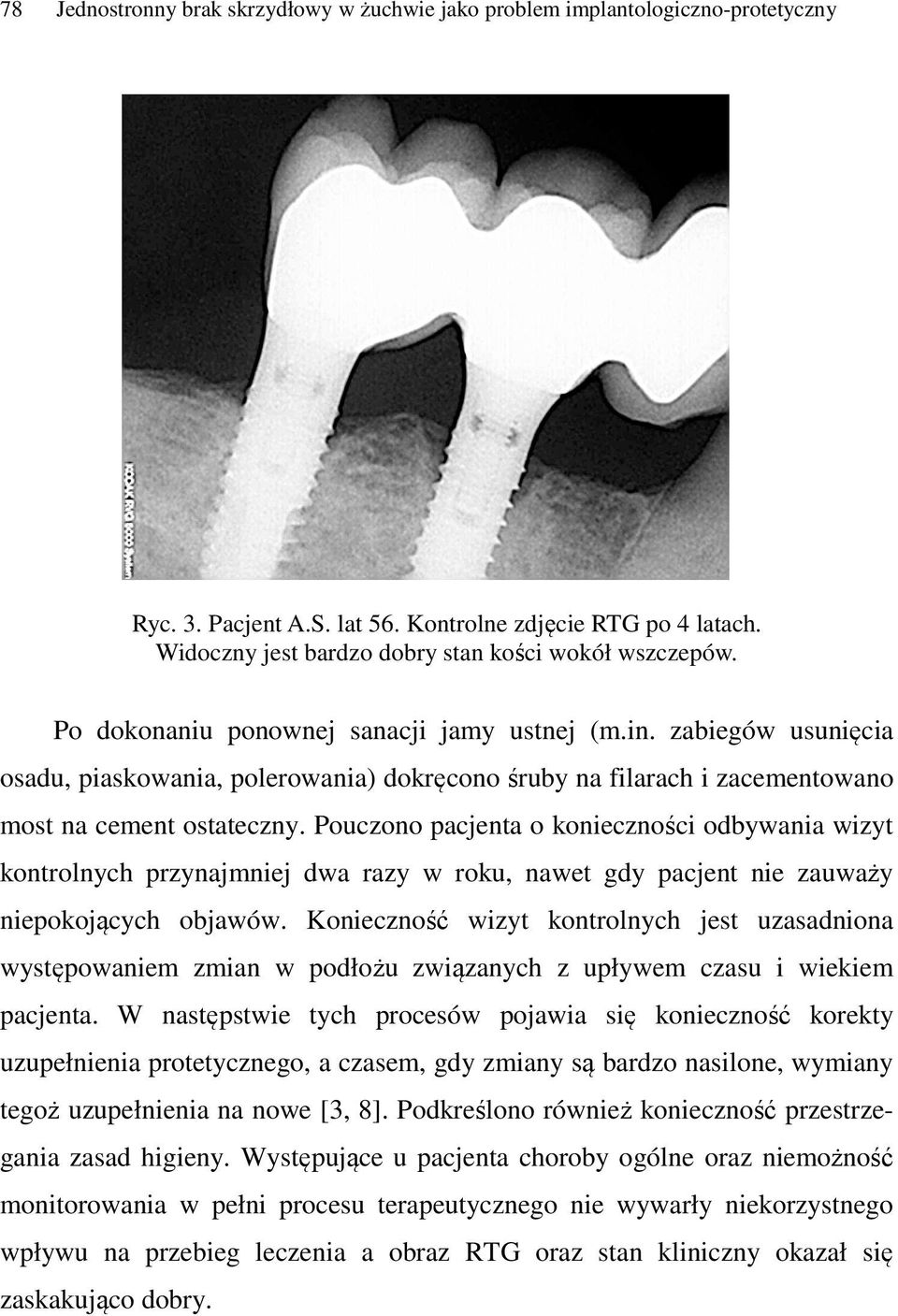 zabiegów usunięcia osadu, piaskowania, polerowania) dokręcono śruby na filarach i zacementowano most na cement ostateczny.