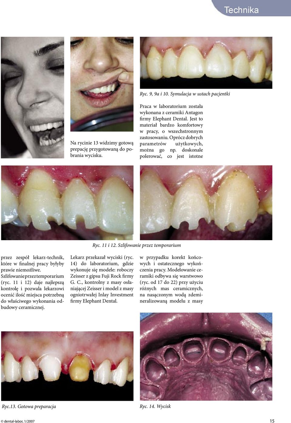 Szlifowanie przez temporarium przez zespół lekarz-technik, które w finalnej pracy byłyby prawie niemożliwe. Szlifowanie przez temporarium (ryc.