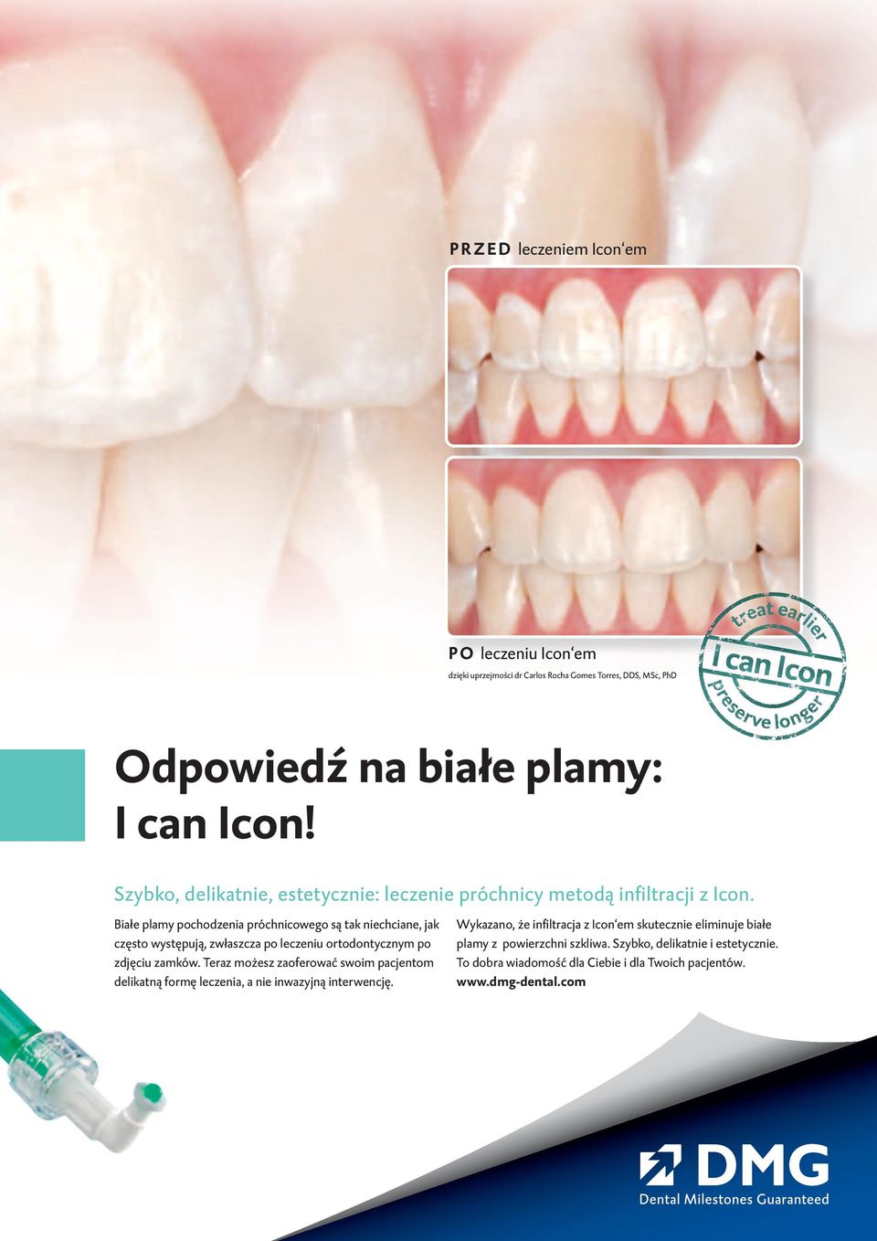 Białe plamy pochodzenia próchnicowego są tak niechciane, jak często występują, zwłaszcza po leczeniu ortodontycznym po zdjęciu zamków.