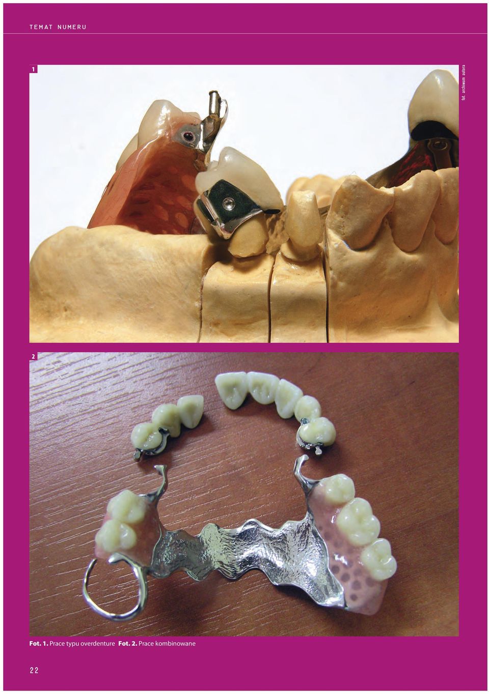 Prace typu overdenture