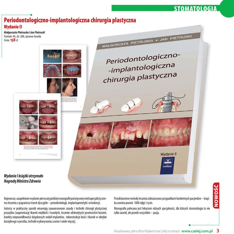 Most tymczasowy obrazujący wykorzystanie reguły 3A-2B; o, p.