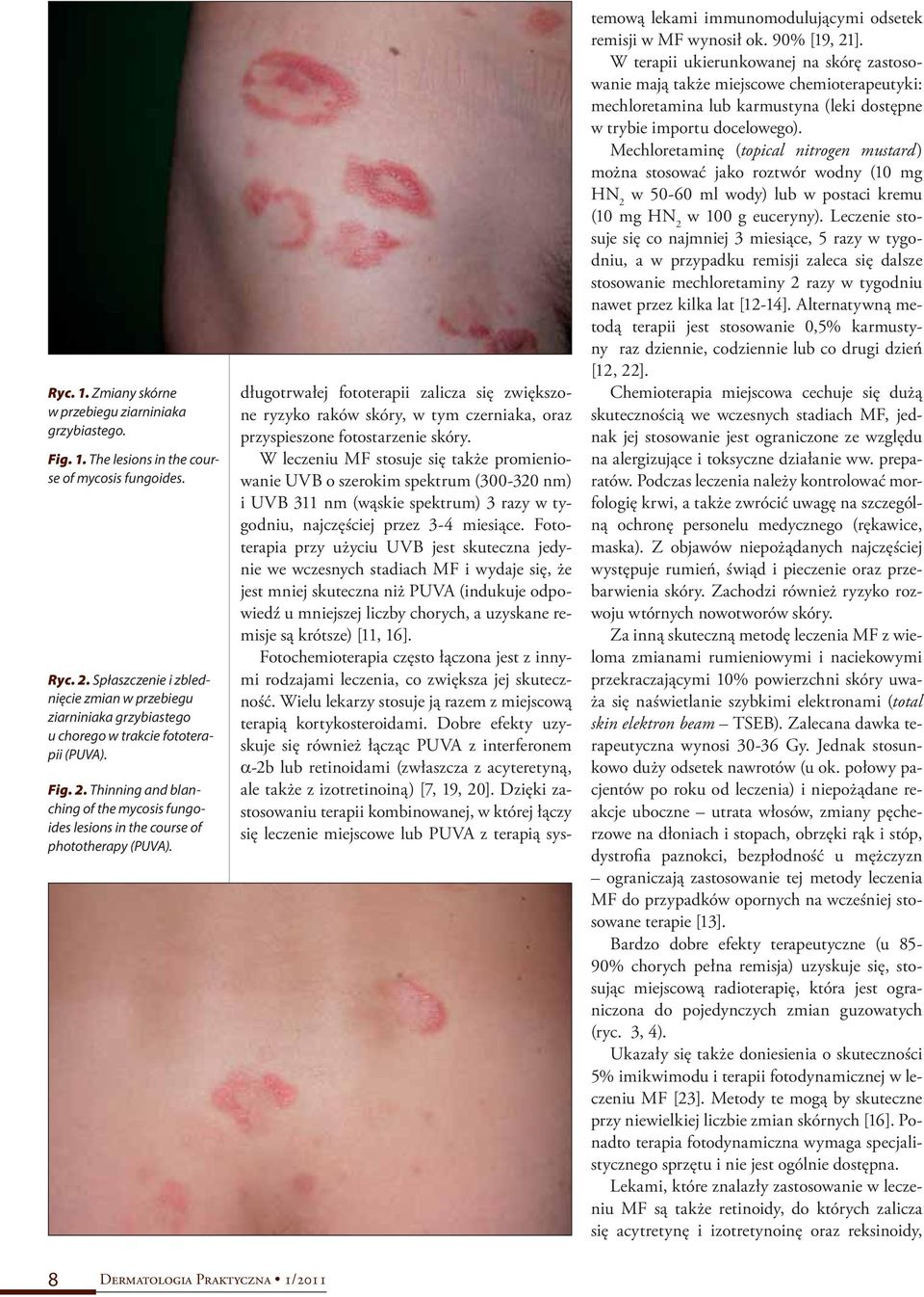 Thinning and blanching of the mycosis fungoides lesions in the course of phototherapy (PUVA).