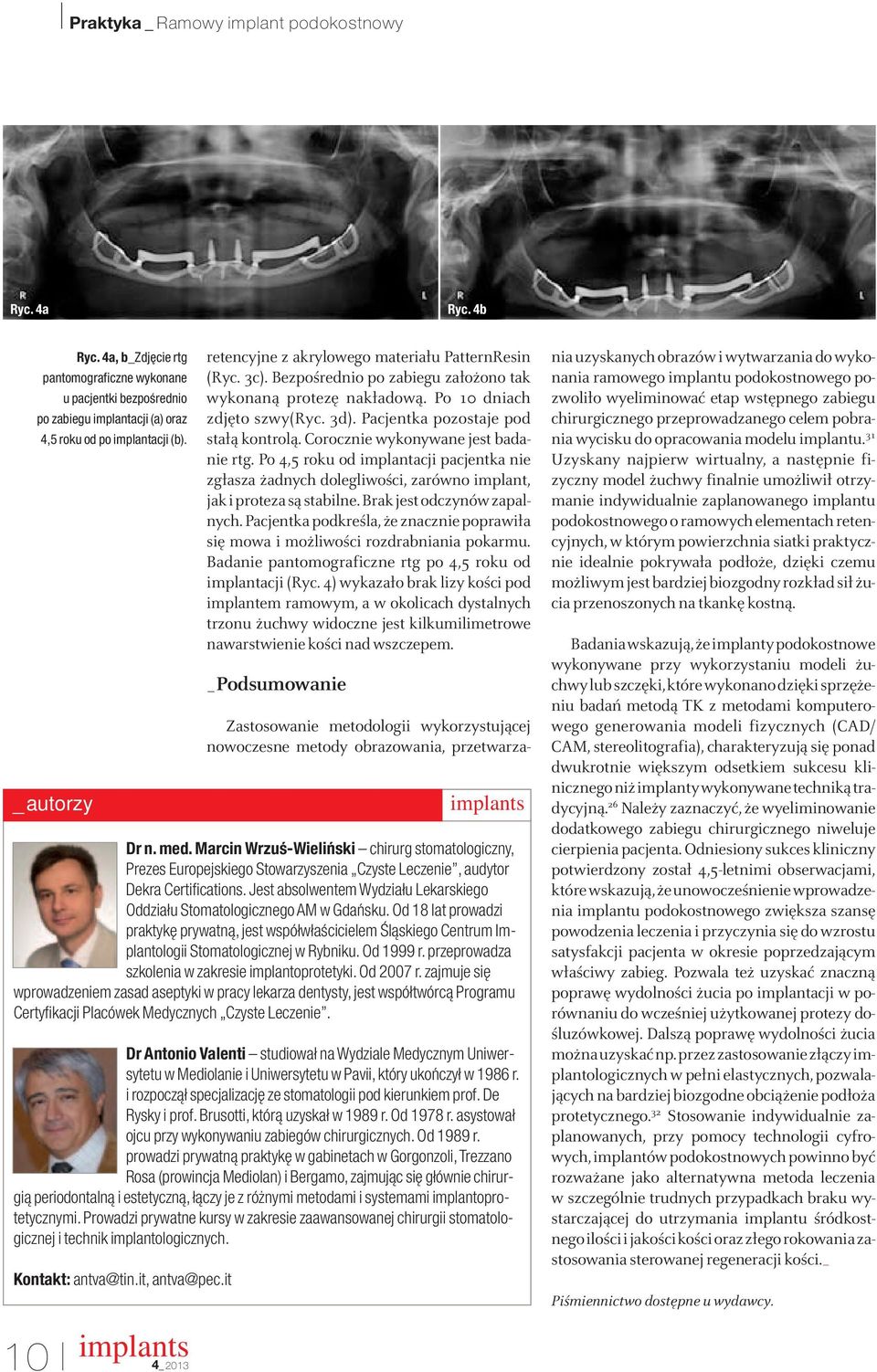 Pacjentka pozostaje pod stałą kontrolą. Corocznie wykonywane jest badanie rtg. Po 4,5 roku od implantacji pacjentka nie zgłasza żadnych dolegliwości, zarówno implant, jak i proteza są stabilne.