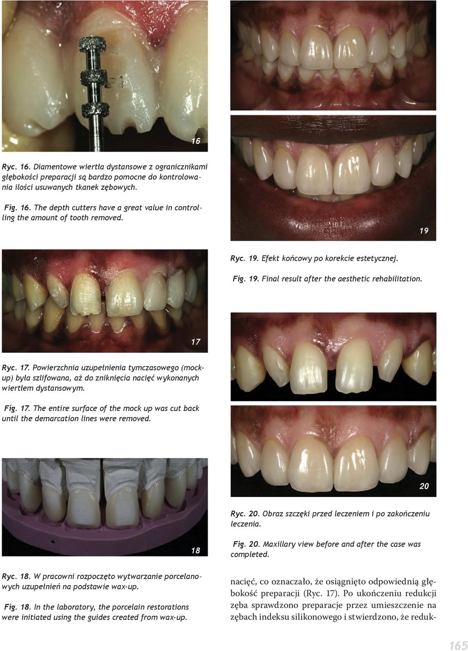 Ryc. 17. Powierzchnia uzupełnienia tymczasowego (mockup) była szlifowana, aż do zniknięcia nacięć wykonanych wiertłem dystansowym. Fig. 17. The entire surface of the mock up was cut back until the demarcation lines were removed.