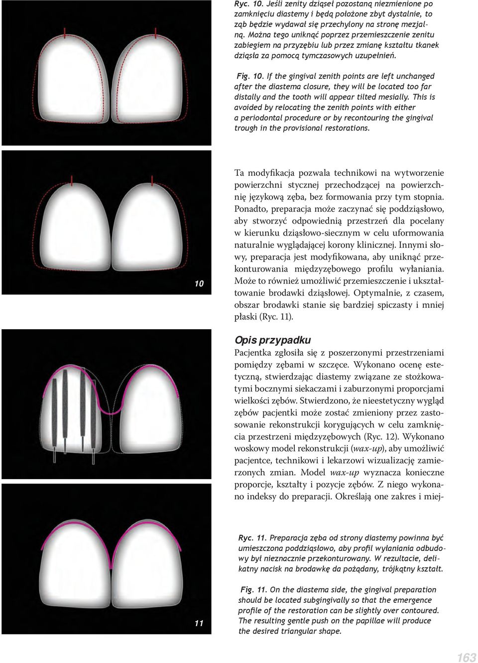 If the gingival zenith points are left unchanged after the diastema closure, they will be located too far distally and the tooth will appear tilted mesially.