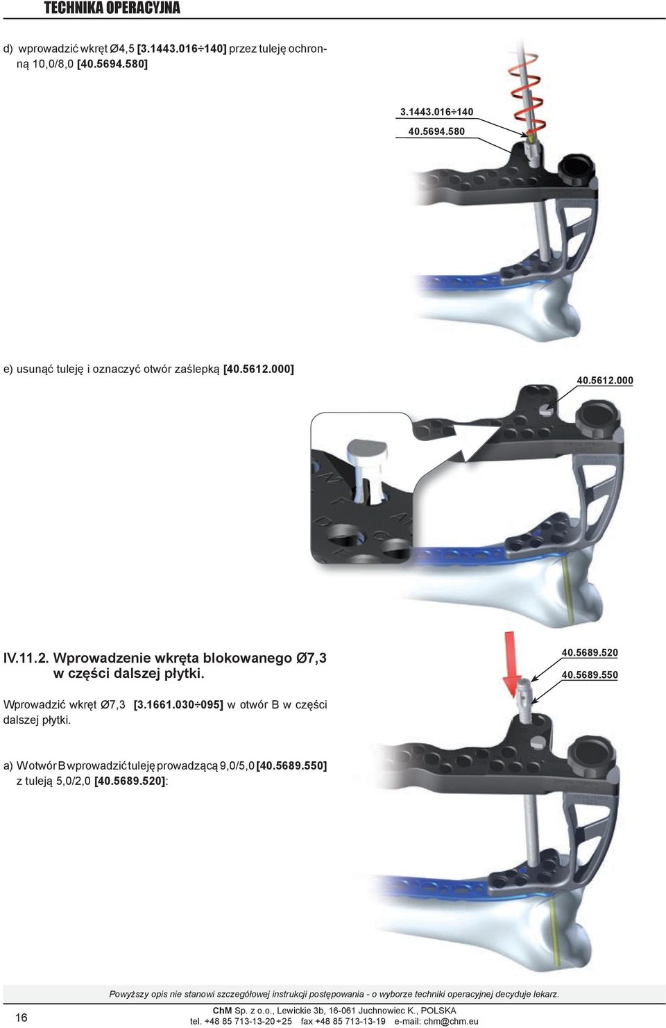 000] 40.5612.000 iv.11.2. Wprowadzenie wkręta blokowanego Ø7,3 w części dalszej płytki. 40.5689.