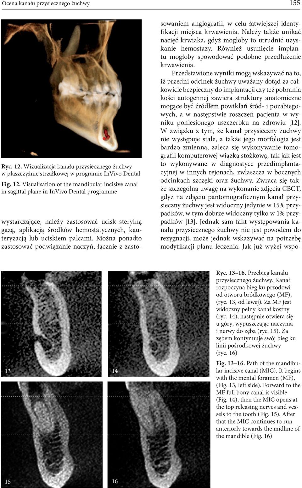 Visualisation of the mandibular incisive canal in sagittal plane in InVivo Dental programme wystarczające, należy zastosować ucisk sterylną gazą, aplikacją środków hemostatycznych, kauteryzacją lub