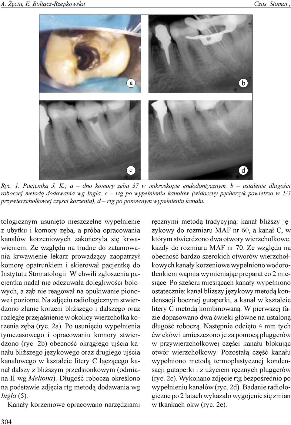 części korzenia), d rtg po ponownym wypełnieniu kanału. tologicznym usunięto nieszczelne wypełnienie z ubytku i komory zęba, a próba opracowania kanałów korzeniowych zakończyła się krwawieniem.