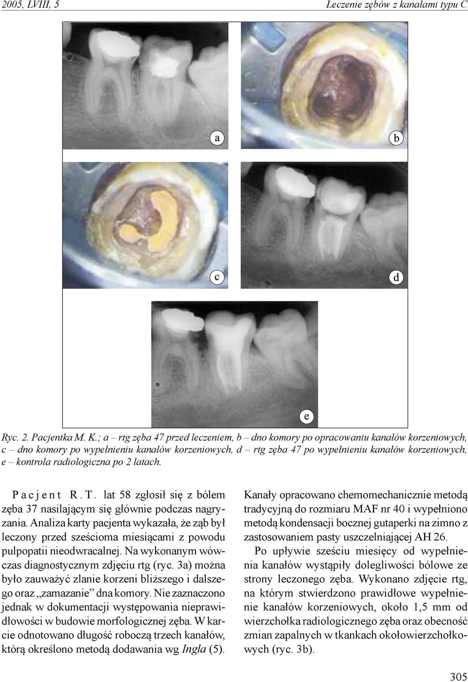 radiologiczna po 2 latach. P a c j e n t R. T. lat 58 zgłosił się z bólem zęba 37 nasilającym się głównie podczas nagryzania.