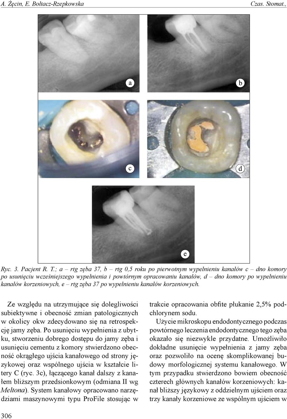 korzeniowych, e rtg zęba 37 po wypełnieniu kanałów korzeniowych.