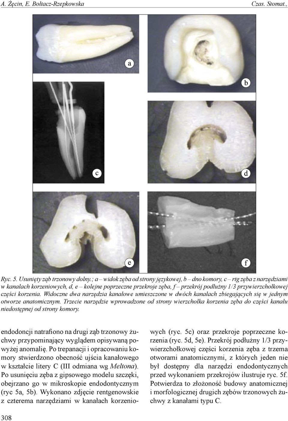 Widoczne dwa narzędzia kanałowe umieszczone w dwóch kanałach zbiegających się w jednym otworze anatomicznym.