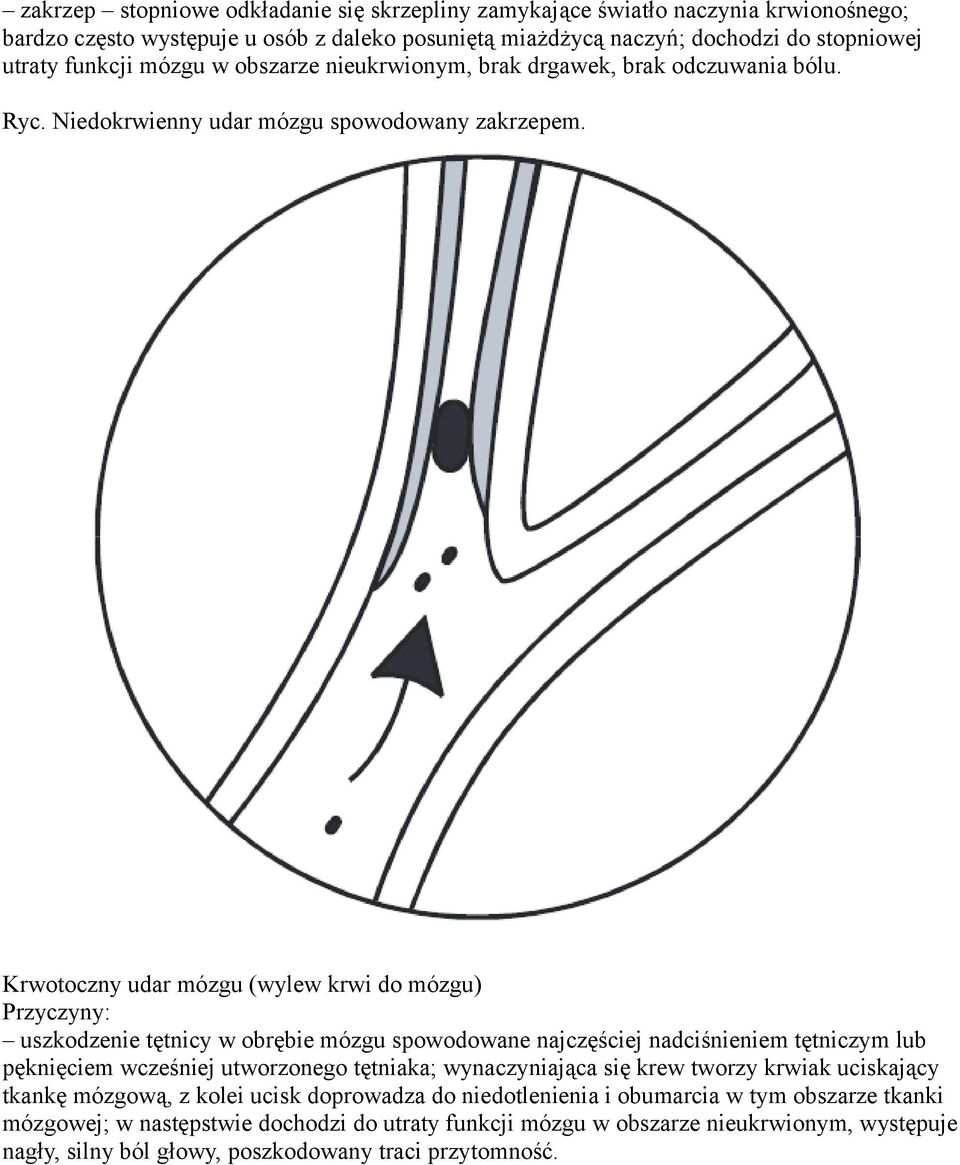 Krwotoczny udar mózgu (wylew krwi do mózgu) Przyczyny: uszkodzenie tętnicy w obrębie mózgu spowodowane najczęściej nadciśnieniem tętniczym lub pęknięciem wcześniej utworzonego tętniaka;