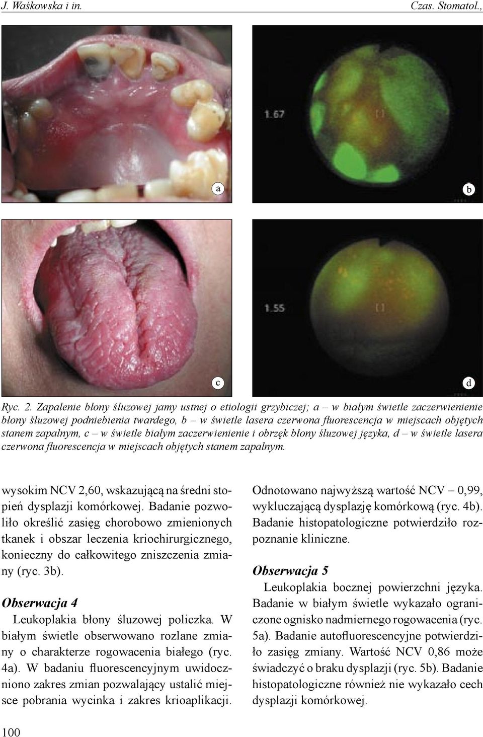 stanem zapalnym, c w świetle białym zaczerwienienie i obrzęk błony śluzowej języka, d w świetle lasera czerwona fluorescencja w miejscach objętych stanem zapalnym.