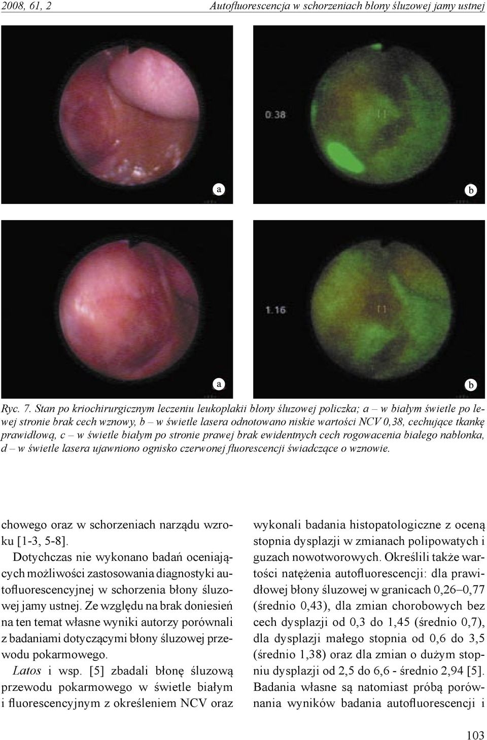 prawidłową, c w świetle białym po stronie prawej brak ewidentnych cech rogowacenia białego nabłonka, d w świetle lasera ujawniono ognisko czerwonej fluorescencji świadczące o wznowie.