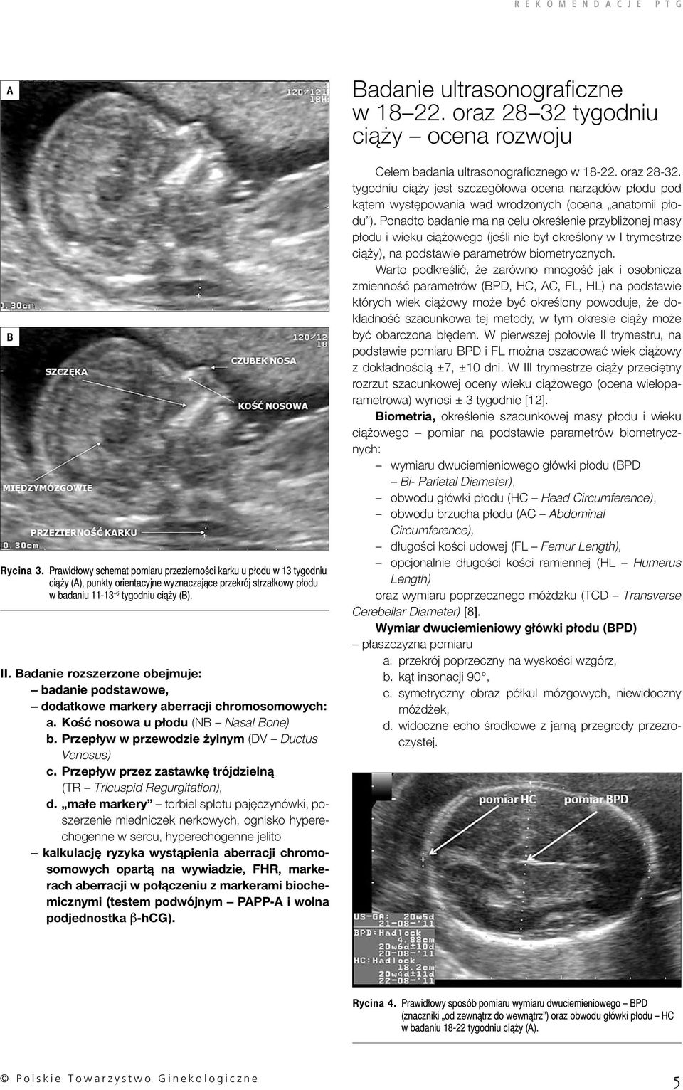 Przepływ przez zastawkę trójdzielną (TR Tricuspid Regurgitation), d.