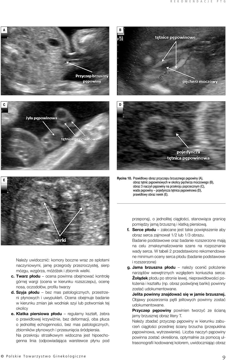 pępowinowa (D), prawidłowy obraz nerek (E). Należy uwidocznić: komory boczne wraz ze splotami naczyniowymi, jamę przegrody przezroczystej, sierp mózgu, wzgórza, móżdżek i zbiornik wielki. c.