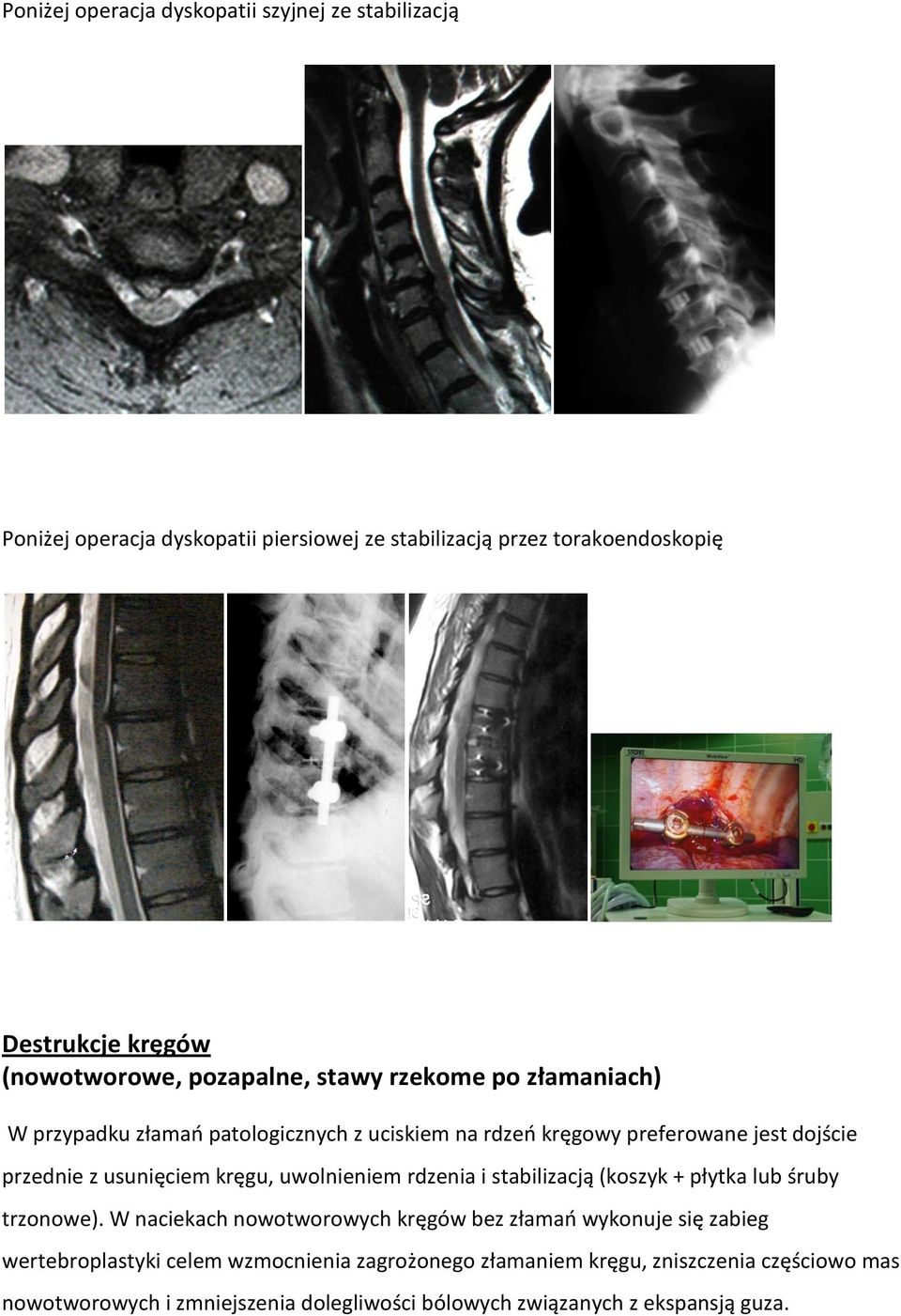 usunięciem kręgu, uwolnieniem rdzenia i stabilizacją (koszyk + płytka lub śruby trzonowe).
