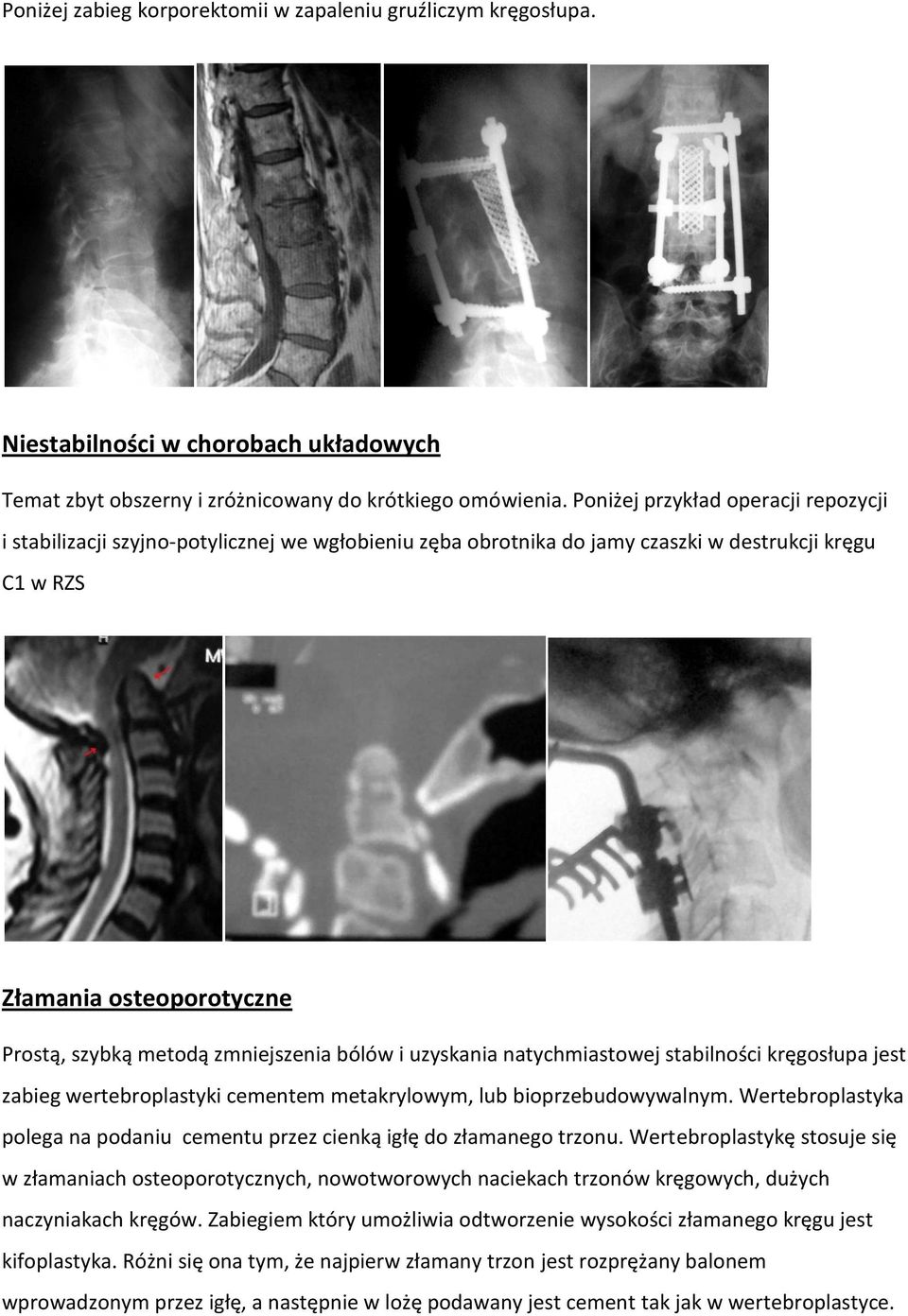 zmniejszenia bólów i uzyskania natychmiastowej stabilności kręgosłupa jest zabieg wertebroplastyki cementem metakrylowym, lub bioprzebudowywalnym.