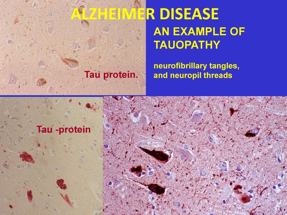 neurofibrillary tangles, and