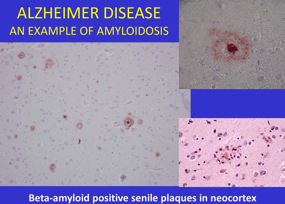 Beta-amyloid positive