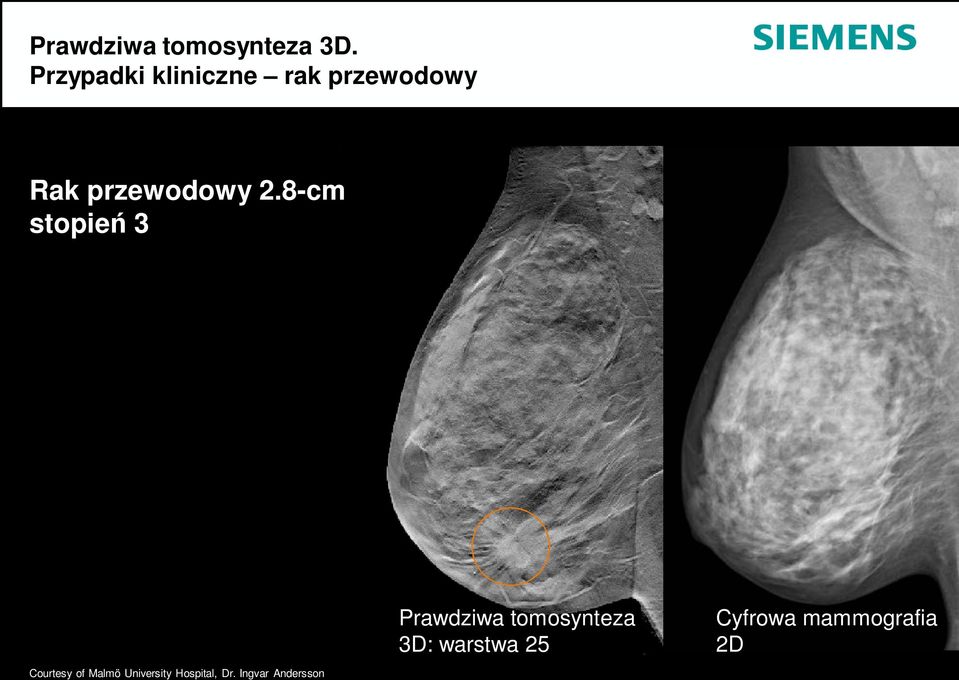 8-cm stopień 3 Courtesy of Malmö University Hospital,