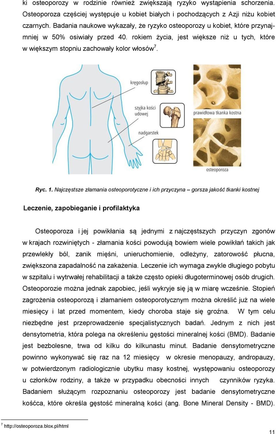 Najczęstsze złamania osteoporotyczne i ich przyczyna gorsza jakość tkanki kostnej Leczenie, zapobieganie i profilaktyka Osteoporoza i jej powikłania są jednymi z najczęstszych przyczyn zgonów w