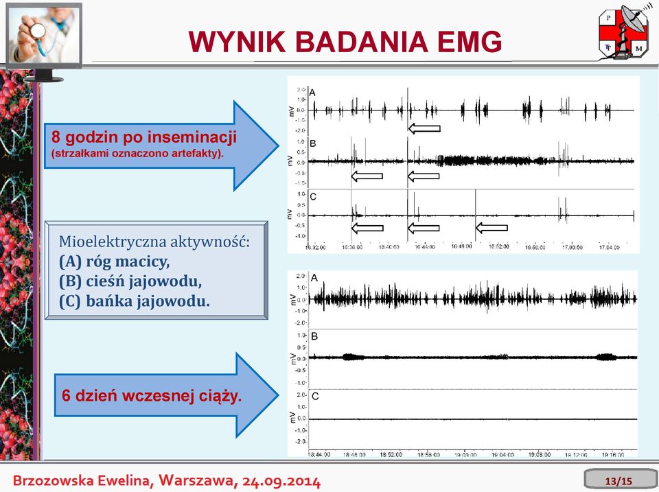 Mioelektryczna aktywność: (A) róg macicy, (B)