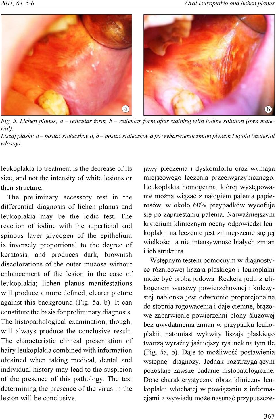 leukoplakia to treatment is the decrease of its size, and not the intensity of white lesions or their structure.