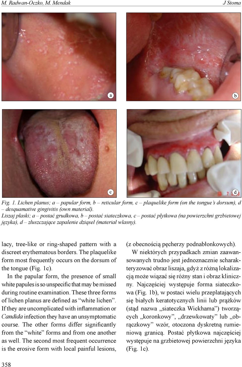 lacy, tree-like or ring-shaped pattern with a discreet erythematous borders. The plaquelike form most frequently occurs on the dorsum of the tongue (Fig. 1c).