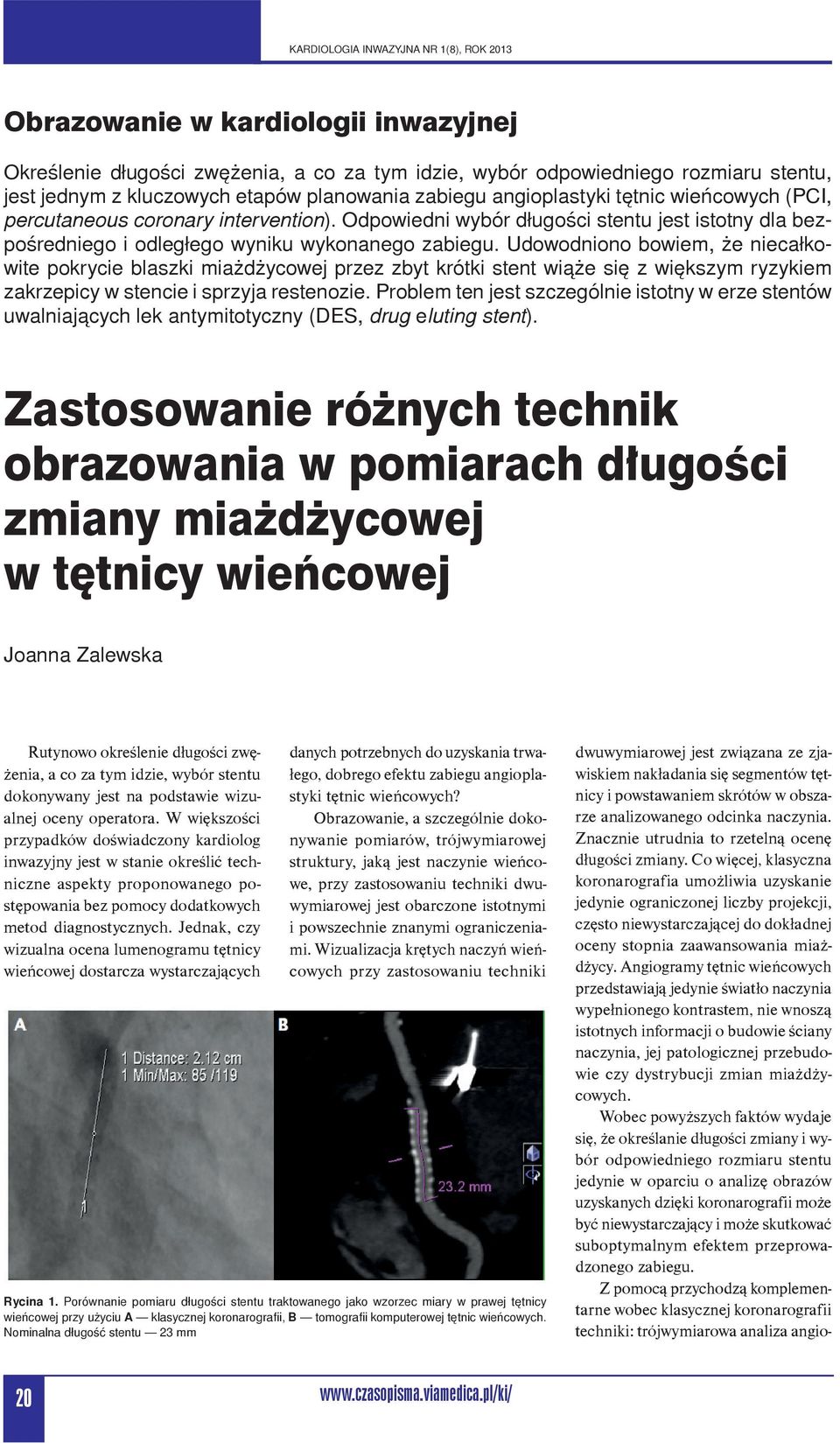 Udowodniono bowiem, że niecałkowite pokrycie blaszki miażdżycowej przez zbyt krótki stent wiąże się z większym ryzykiem zakrzepicy w stencie i sprzyja restenozie.