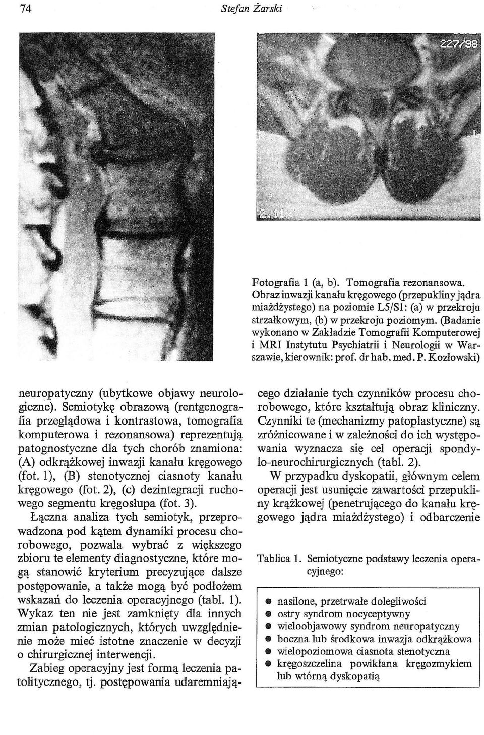 Semiotykę obrazową (rentgenografia przeglądowa i kontrastowa, tomografia komputerowa i rezonansowa) reprezentują patognostyczne dla tych chorób znamiona: (A) odkrążkowej inwazji kanału kręgowego (fot.