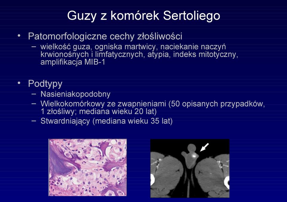 amplifikacja MIB-1 Podtypy Nasieniakopodobny Wielkokomórkowy ze zwapnieniami (50