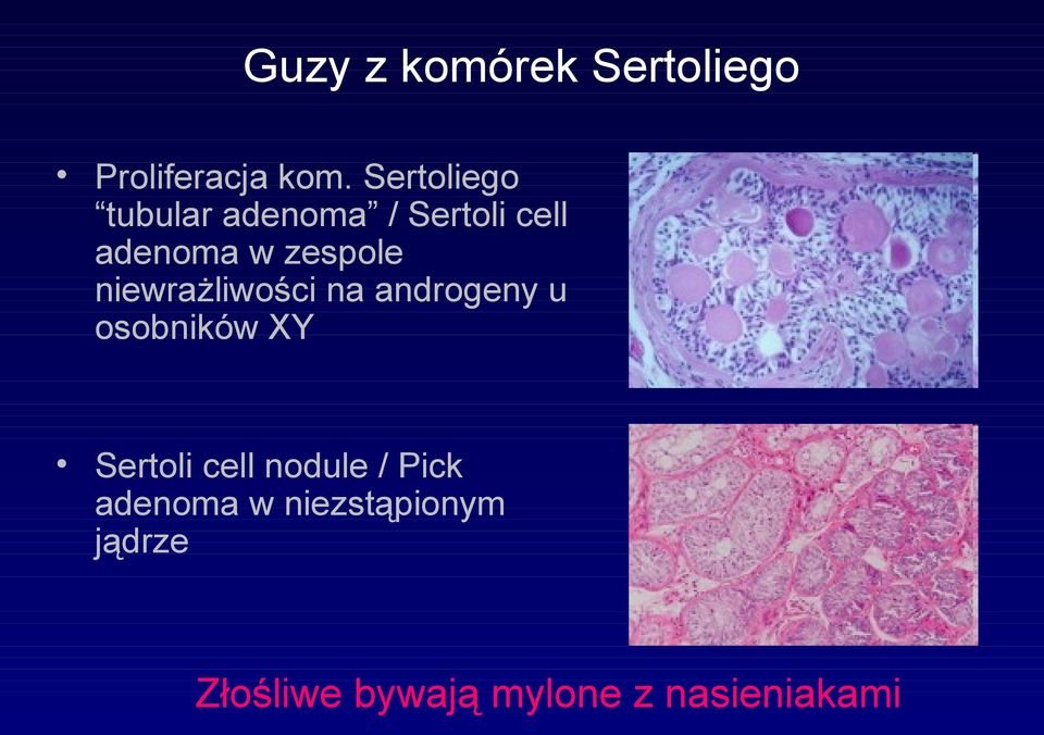 niewrażliwości na androgeny u osobników XY Sertoli cell