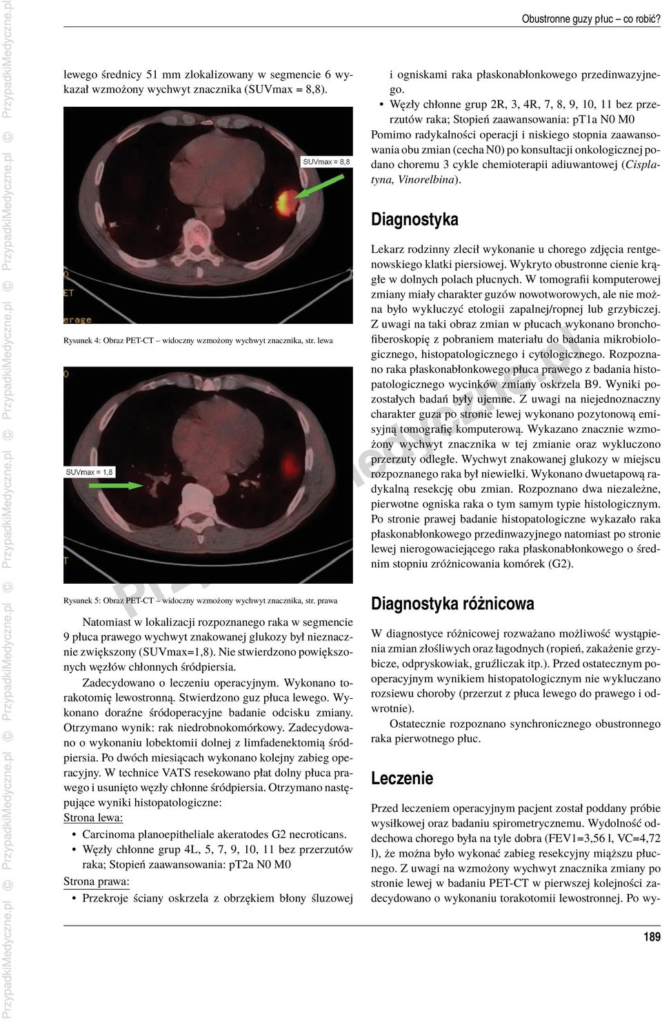 onkologicznej podano choremu 3 cykle chemioterapii adiuwantowej (Cisplatyna, Vinorelbina). Diagnostyka Rysunek 4: Obraz PET-CT widoczny wzmożony wychwyt znacznika, str.