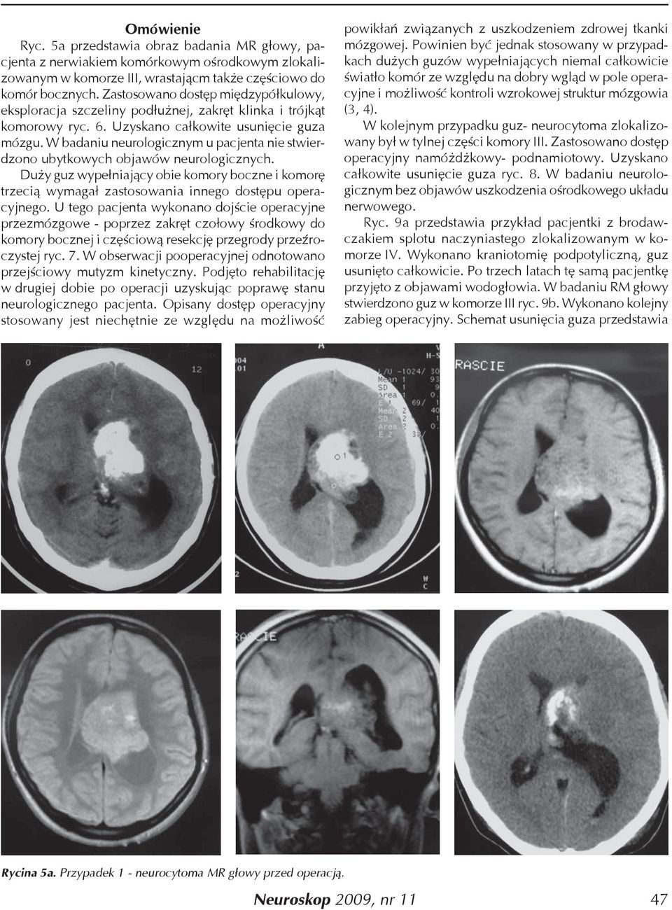 W badaniu neurologicznym u pacjenta nie stwierdzono ubytkowych objawów neurologicznych. Duży guz wypełniający obie komory boczne i komorę trzecią wymagał zastosowania innego dostępu operacyjnego.