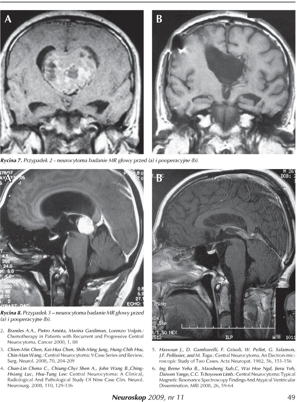 : Central Neurocytoma: 9 Case Series and Review. Surg. Neurol. 2008, 70, 204-209 4. Chun-Lin Chena C., Chiung-Chyi Shen A., John Wang B.