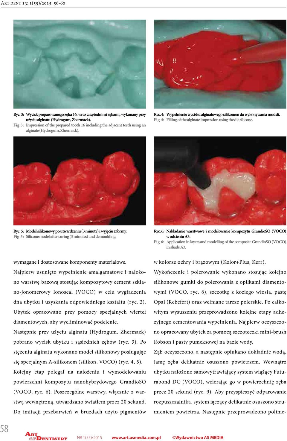 Fig 4: Filling of the alginate impression using the die silicone. Ryc. 5: Model silikonowy po utwardzeniu (3 minuty) i wyjęciu z formy. Fig 5: Silicone model after curing (3 minutes) and demoulding.