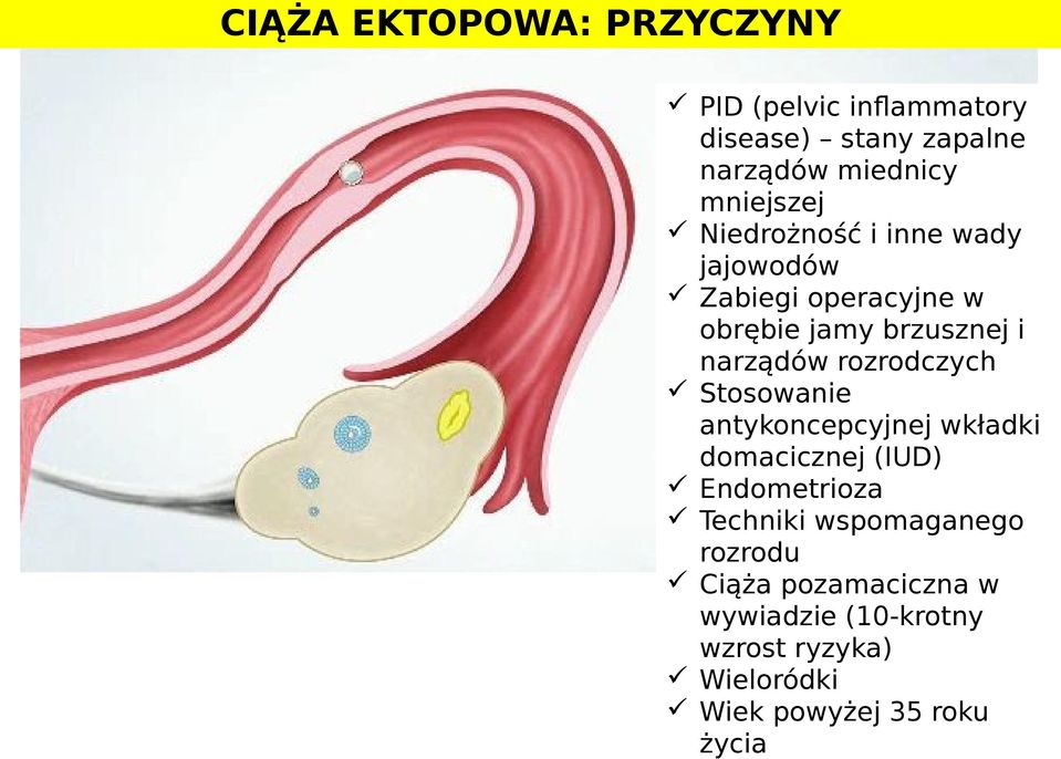 rozrodczych Stosowanie antykoncepcyjnej wkładki domacicznej (IUD) Endometrioza Techniki