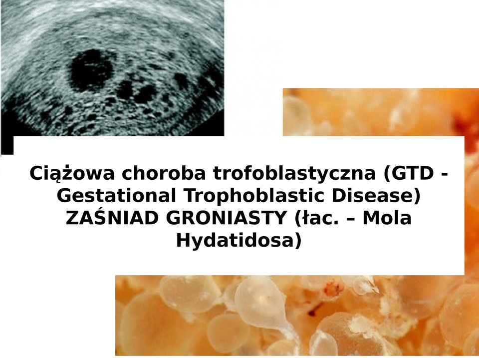 burzy śnieżnej (GTD Gestational Trophoblastic