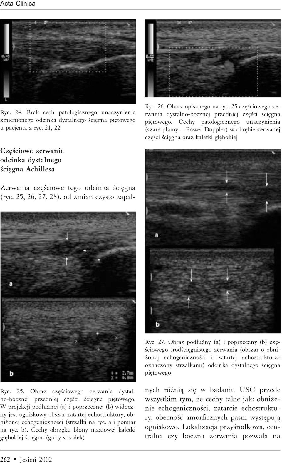Cechy patologicznego unaczynienia (szare plamy Power Doppler) w obræbie zerwanej czæ ci ciægna oraz kaletki gææbokiej Ryc. 27.