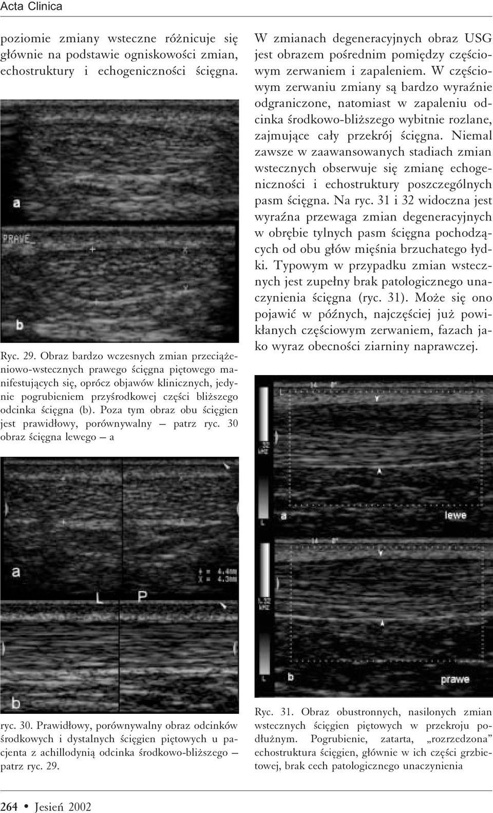 Poza tym obraz obu ciægien jest prawidæowy, porównywalny patrz ryc. 30 obraz ciægna lewego a W zmianach degeneracyjnych obraz USG jest obrazem po rednim pomiædzy czæ ciowym zerwaniem i zapaleniem.