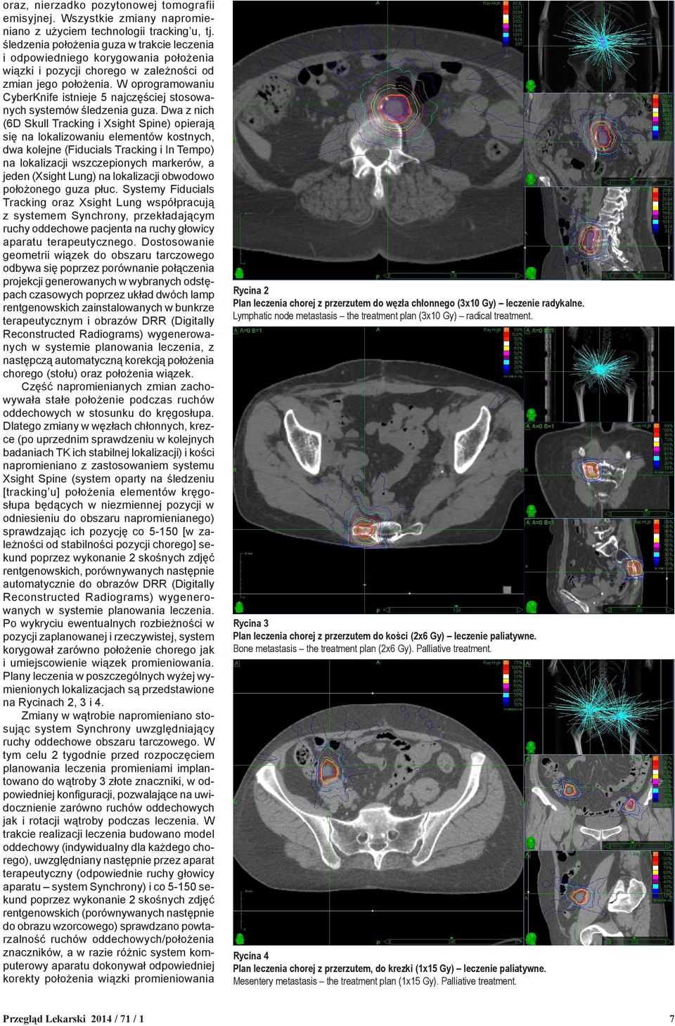 W oprogramowaniu CyberKnife istnieje 5 najczęściej stosowanych systemów śledzenia guza.