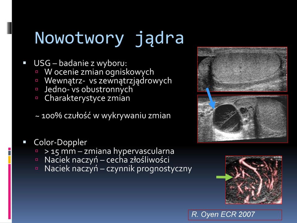 zmian ~ 100% czułość w wykrywaniu zmian Color-Doppler > 15 mm zmiana