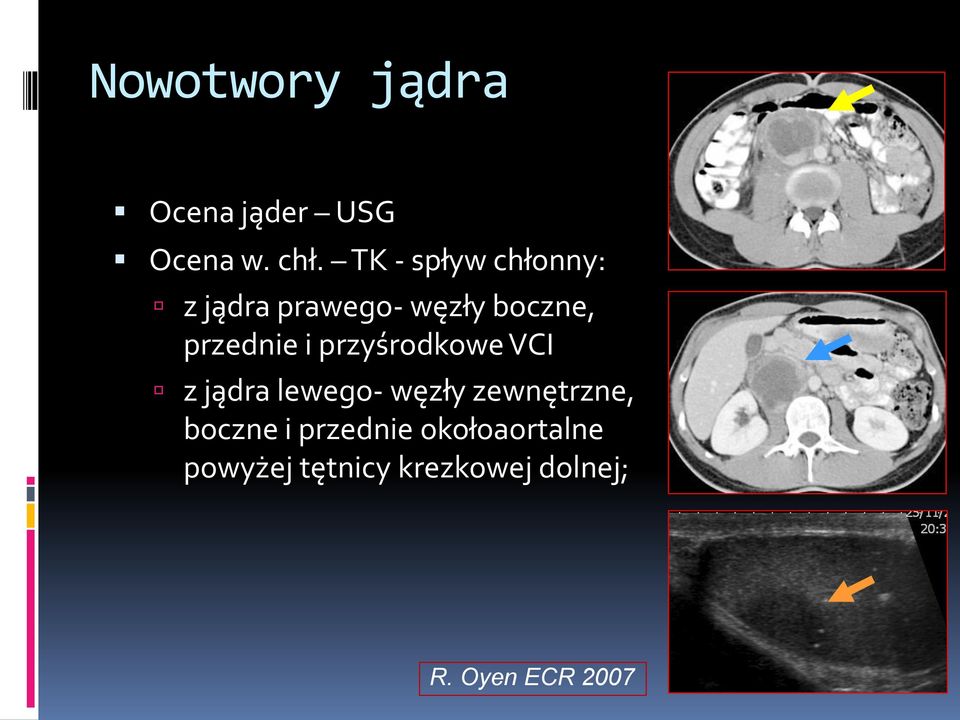 i przyśrodkowe VCI z jądra lewego- węzły zewnętrzne, boczne